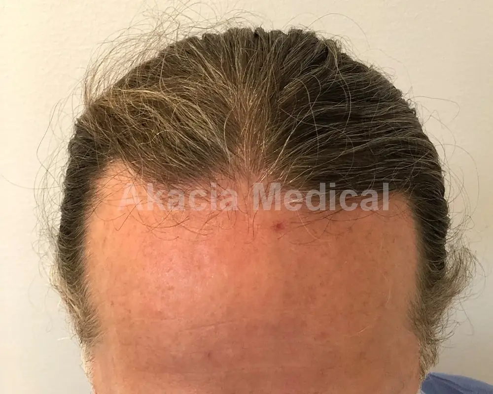 Önce - före behandling