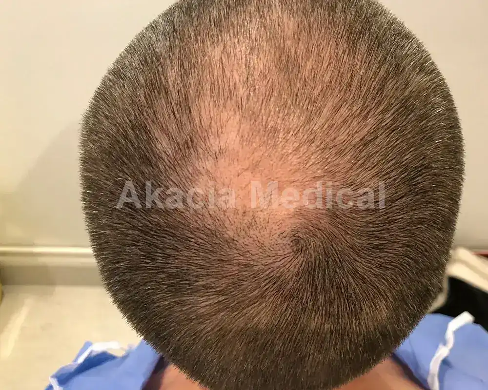 Före - före behandling