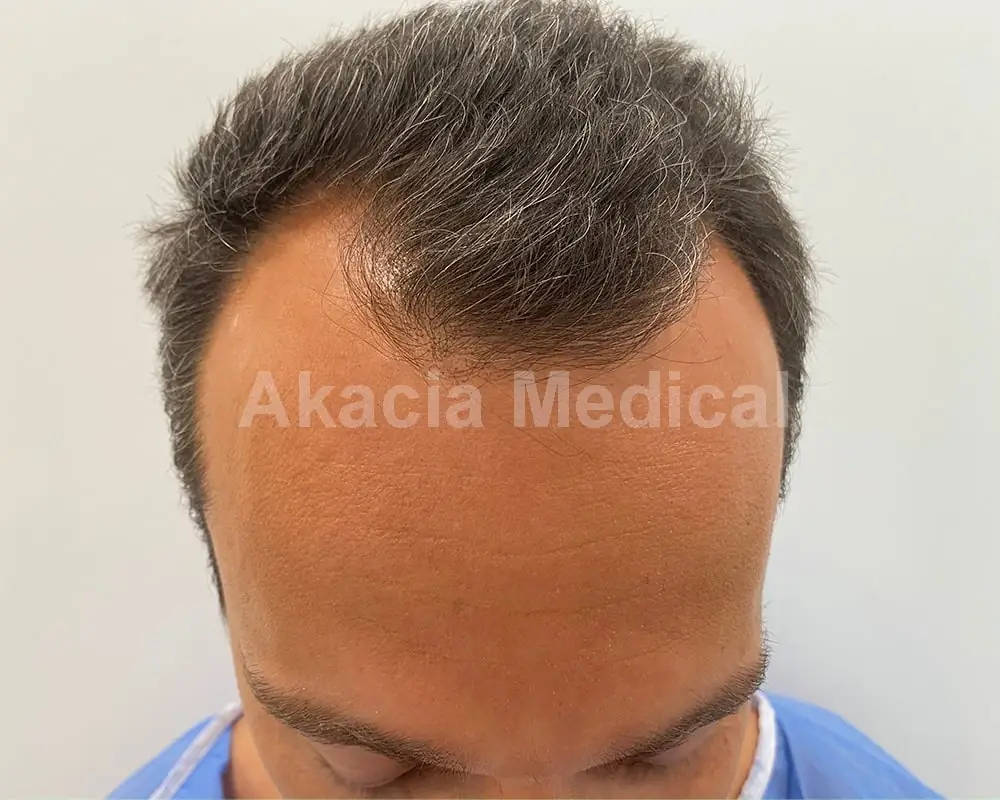 Önce - före behandling