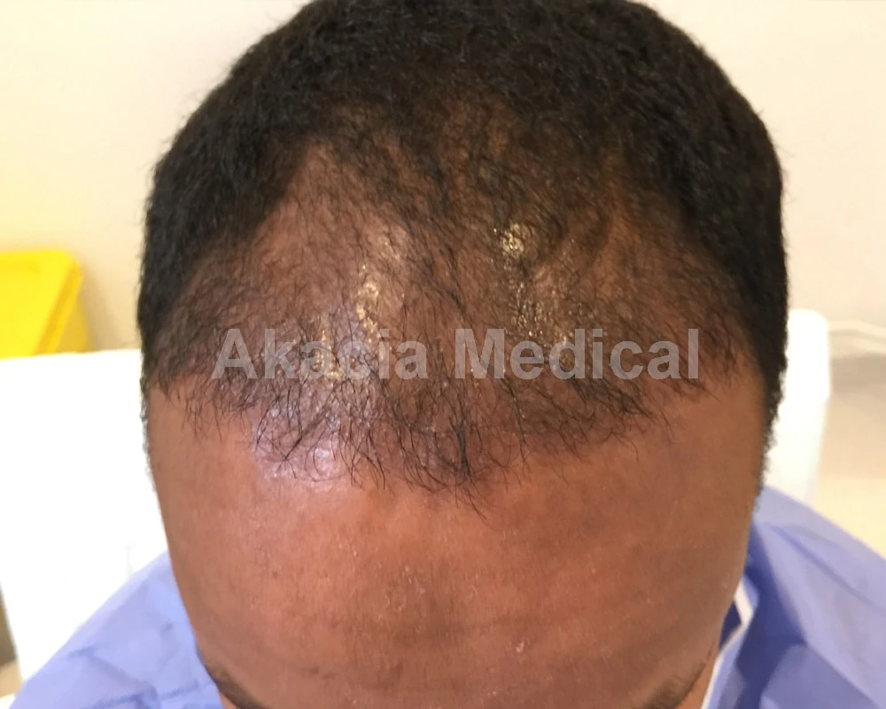 Före - före behandling