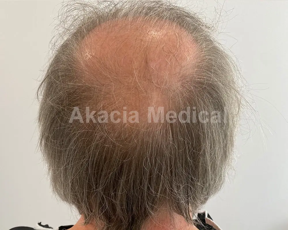 Önce - före behandling