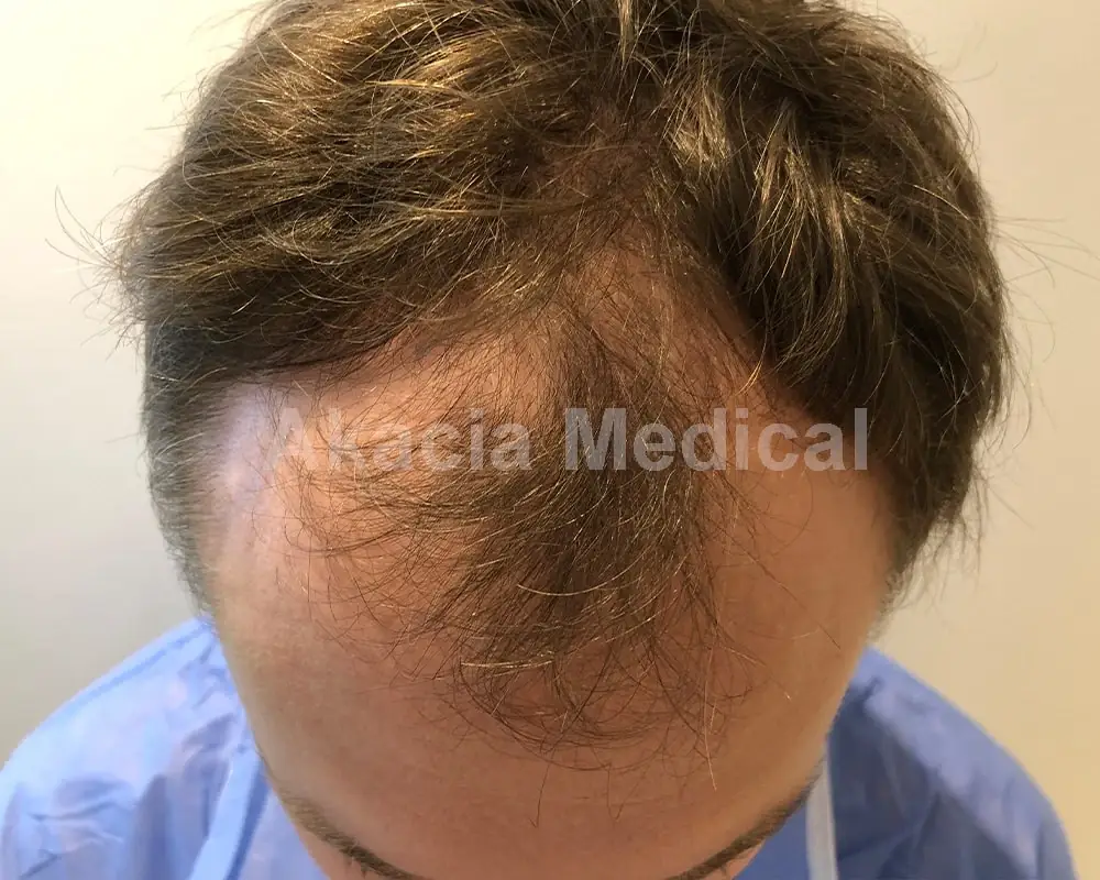 Före - före behandling