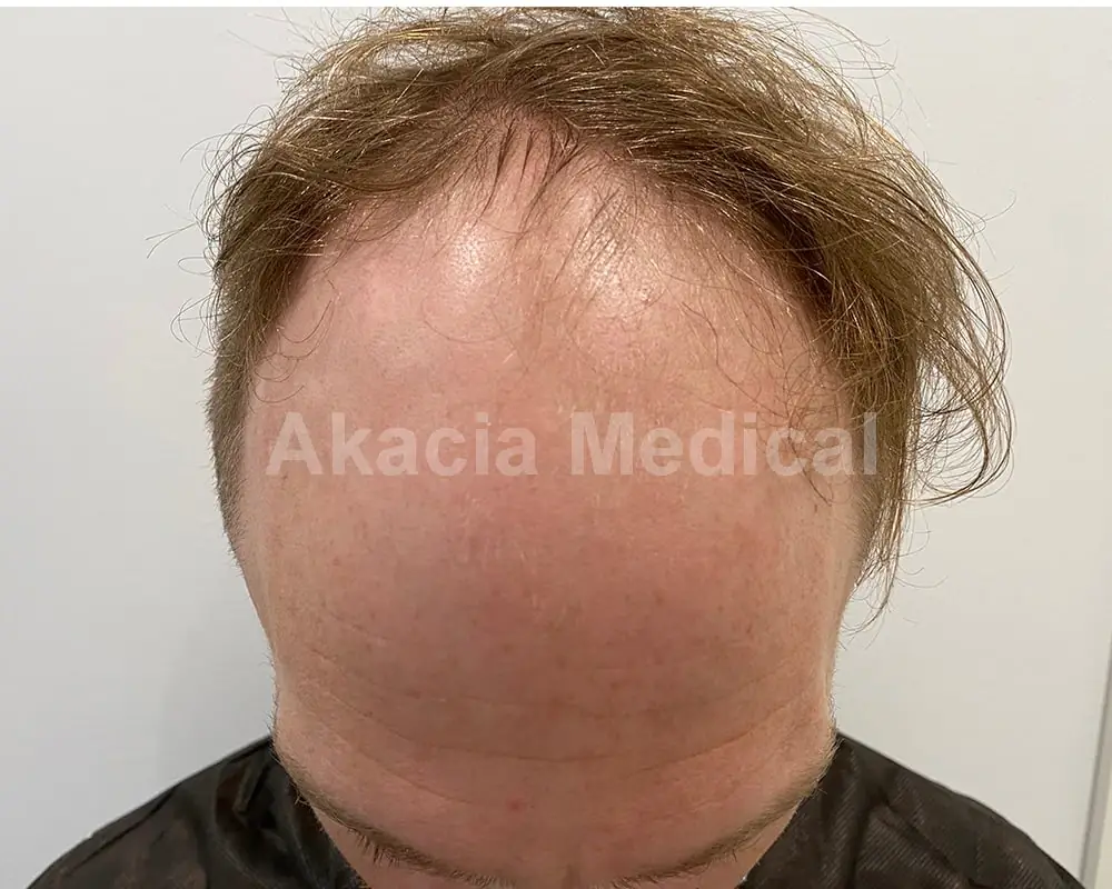 Önce - före behandling