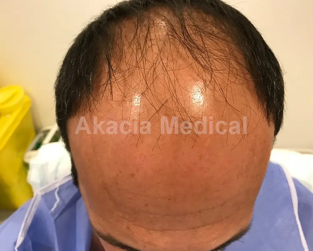 Före - före behandling