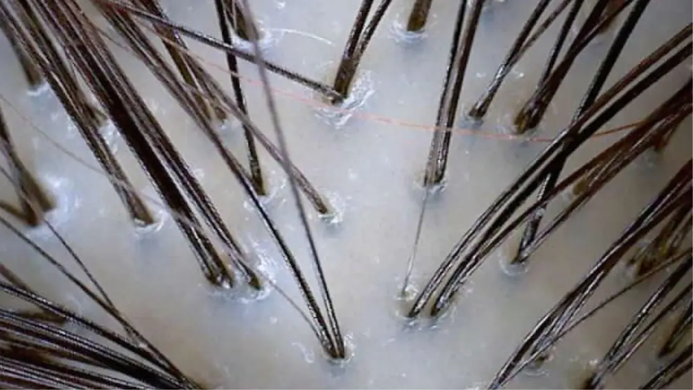 Analyse af hovedbunden med et mikrokamera - professionel diagnose