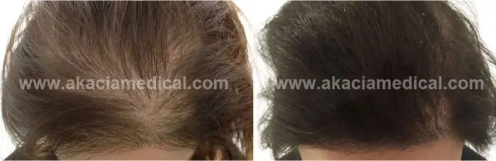 Öncesi ve sonrası resimler - kadınlar için saç ekimi