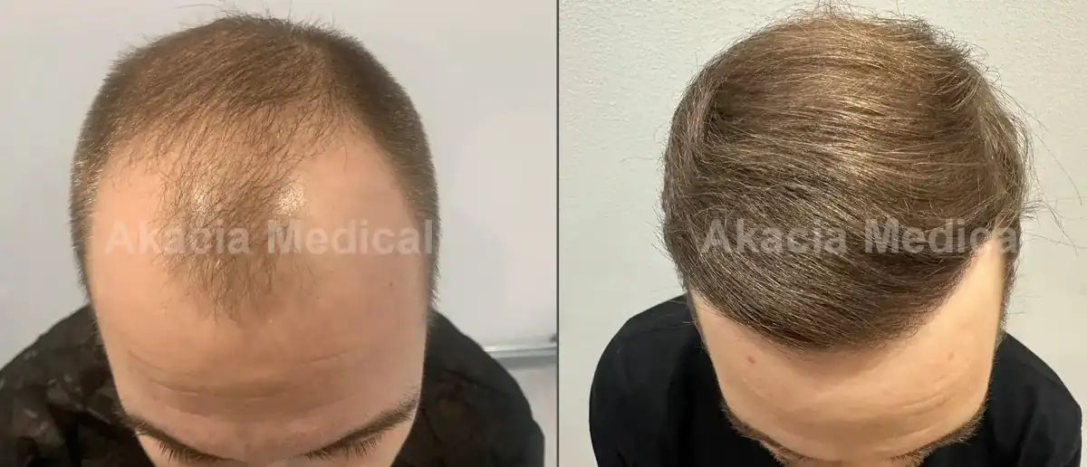 Case med genskabt hårgrænse