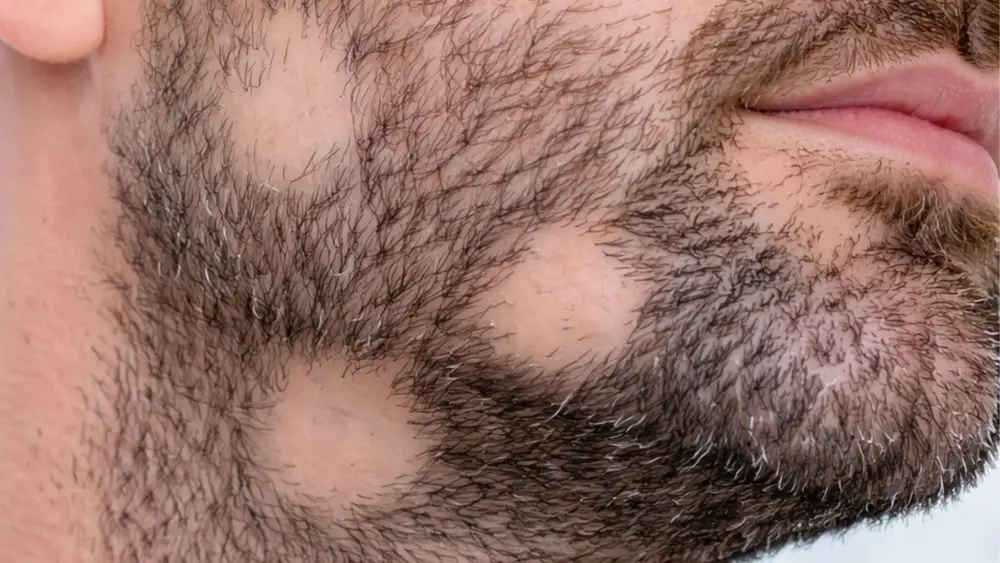 Alopecia areata barbae - patchy hair loss in the beard
