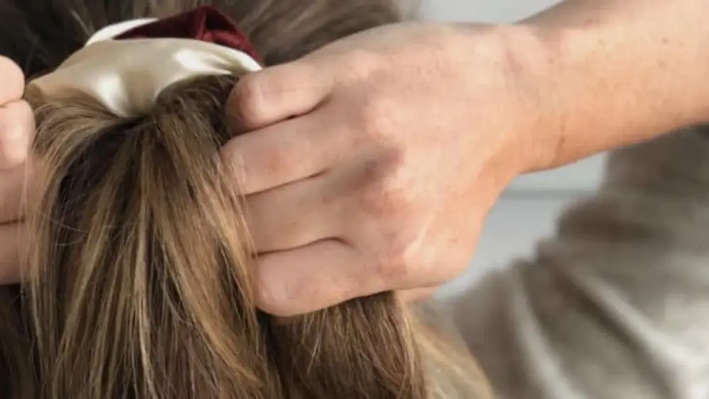 Traction alopecia - hårtab forårsaget af stramme frisurer