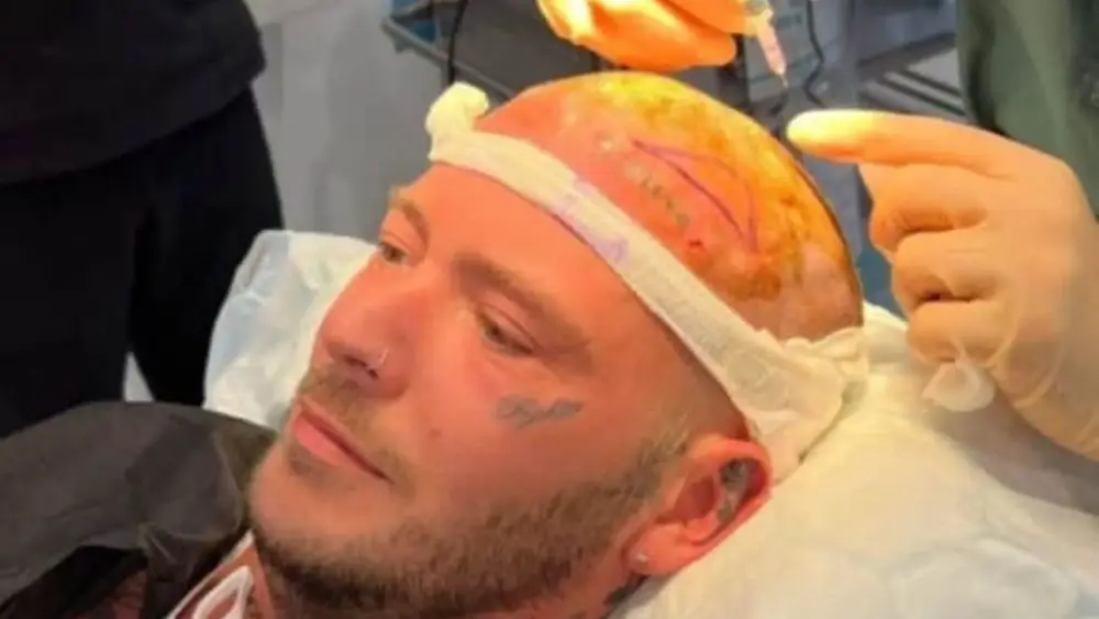 Joakim Lundells hårtransplantation - en personlig historie