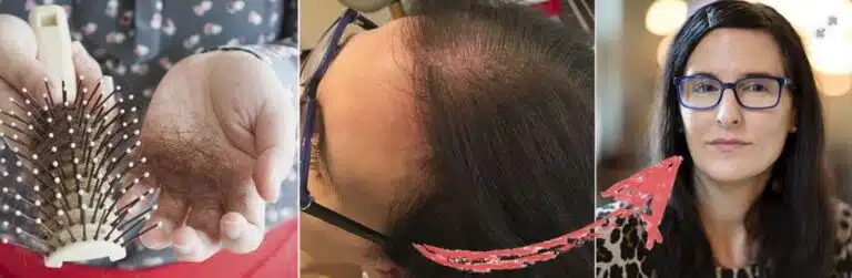 Hårtab og behandlingsresultater