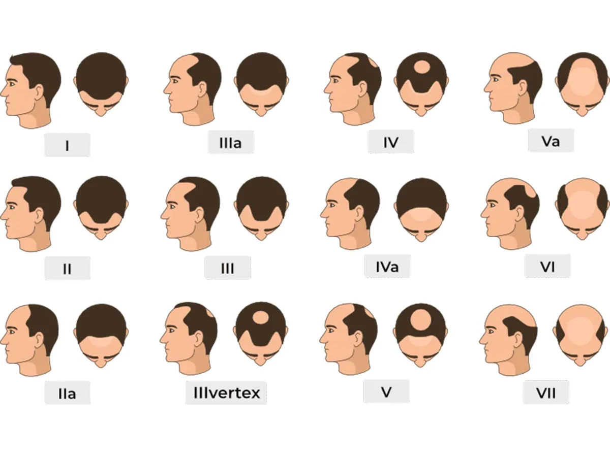 Skala til vurdering af hårtab