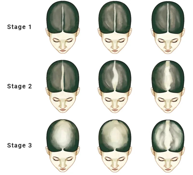 Ludvig-skalaen for kvindeligt hårtab