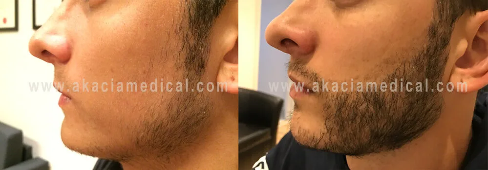 Resultat efter skægtransplantation