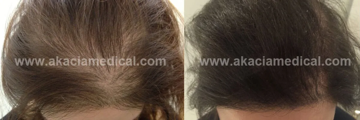 Saç ekimi öncesi ve sonrası kadın fotoğrafları