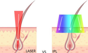 Laser vs IPL